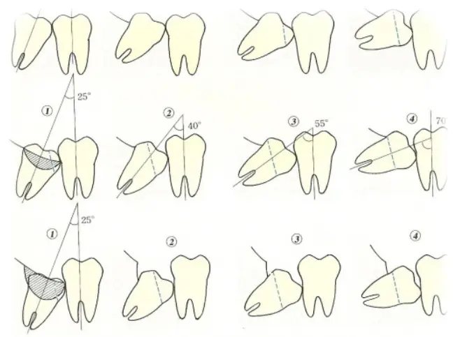 Estrazione del dente del giudizio: immagine dal sito dell'ambulatorio