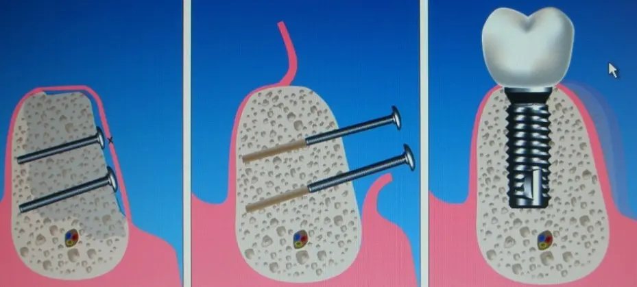 Innesti di osso: immagine dal sito dell'ambulatorio