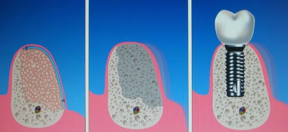 L'osso rigenerato riceve l'impianto