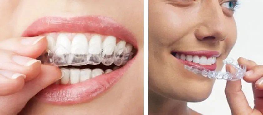 Allineatori trasparenti Invisalign