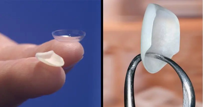 Faccette Lumineers: immagine dal sito dell'ambulatorio
